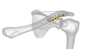 Acumed Clavicle Plating System - Medical + Optical